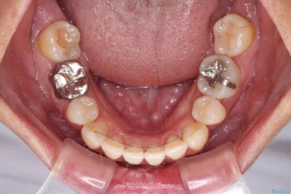 八重歯で口元が膨れている　ワイヤー装置での抜歯矯正 治療後画像