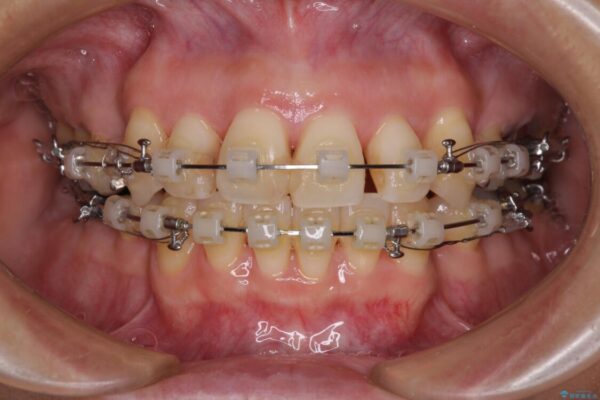 八重歯で口元が膨れている　ワイヤー装置での抜歯矯正 治療途中画像