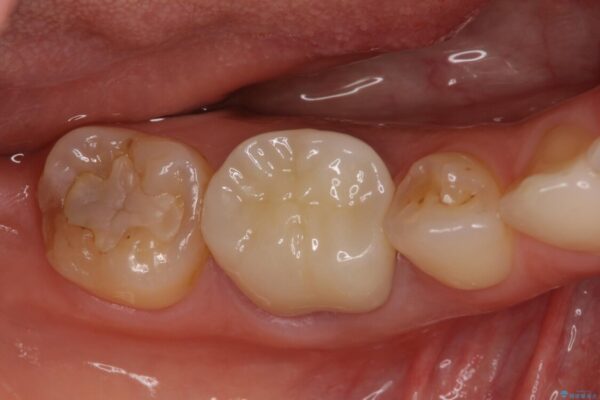 奥歯の歯茎から膿が出る　根管治療とオールセラミッククラウン アフター