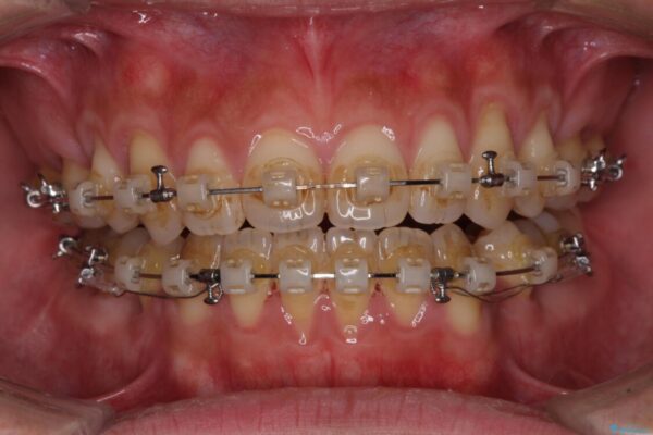 隙間が空いて突出した前歯を治したい　ワイヤー装置による抜歯矯正 治療途中画像
