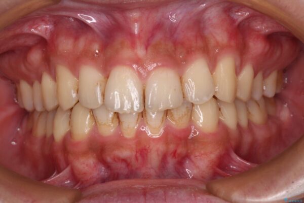 前歯のデコボコをスッキリ改善　インビザライン矯正 治療途中画像