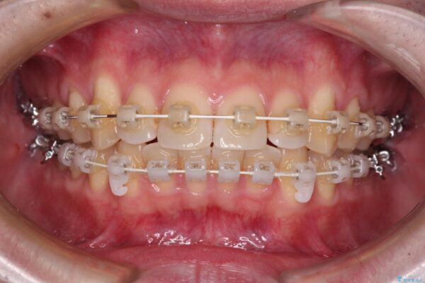 前歯のデコボコを治したい　ワイヤー装置でお手軽に矯正治療 治療途中画像