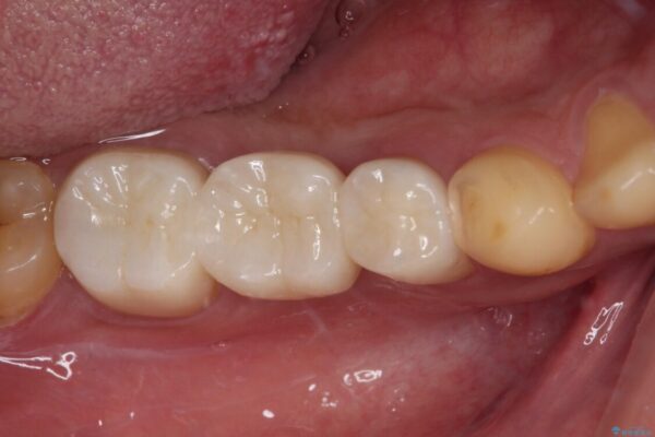 放置した虫歯　奥歯のオールセラミックブリッジ治療 アフター