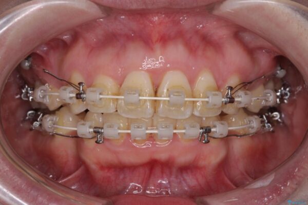 出っ歯による口の閉じにくさを治したい　ワイヤー装置を用いた抜歯矯正 治療途中画像