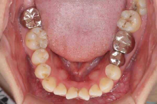 八重歯と開咬を治したい　目立たないハーフリンガル矯正 治療前画像