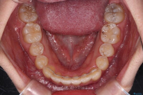 【モニター】八重歯と前歯のクロスバイト　ワイヤーを併用しインビザラインで矯正治療 治療後画像