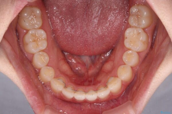 すきっ歯とオープンバイト　インビザライン・ライトで改善 治療後画像