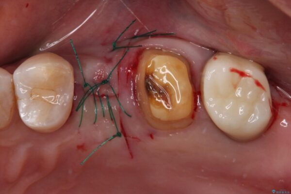 治療後に歯茎から出血　インプラントとオールセラミッククラウンの補綴治療 治療後画像