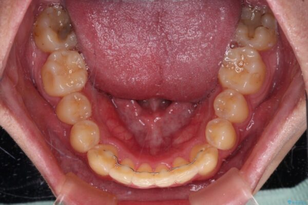 前歯のデコボコを治したい　インビザライン矯正治療 治療後画像