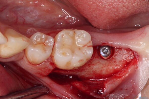 部分矯正を併用した奥歯のインプラント治療 治療途中画像