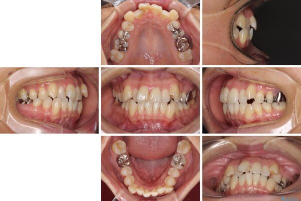 八重歯で口元が膨れている　ワイヤー装置での抜歯矯正 治療前画像