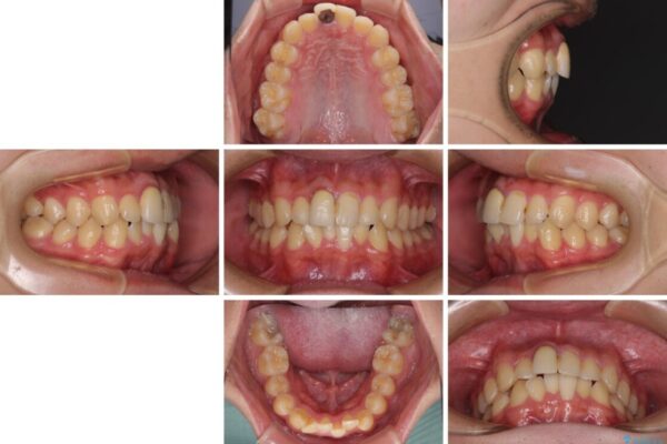 前歯のデコボコを治したい　インビザライン矯正治療 治療前画像