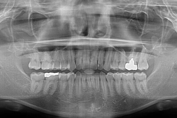 前歯のデコボコを治したい　ワイヤー装置でお手軽に矯正治療 治療後画像