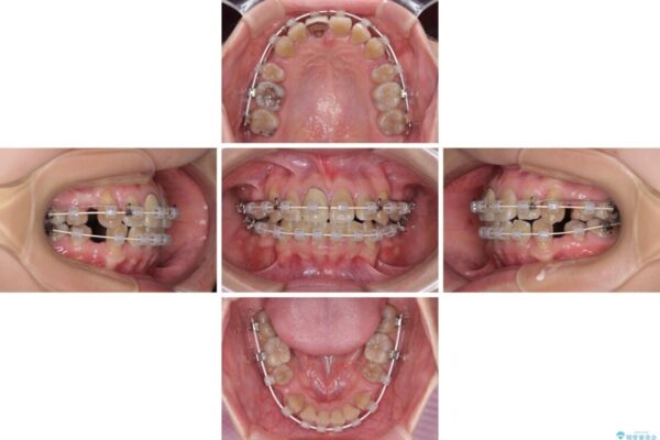 八重歯とクロスバイト　目立たないワイヤー装置での抜歯矯正 治療途中画像
