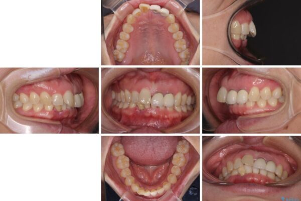 前歯のインプラント治療　折角なので矯正治療できれいな歯並びに 治療前画像