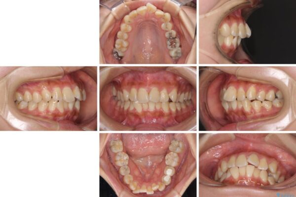 デコボコで磨きにくい前歯をスッキリと　インビザライン矯正 治療前画像