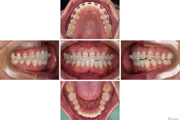 内側にある歯が干渉する　上顎前歯の部分矯正 治療途中画像