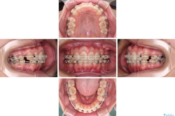 前歯の出っ歯と口の閉じにくさが気になる　目立たないワイヤー装置での抜歯矯正 治療途中画像