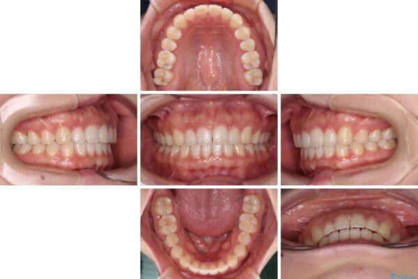 すきっ歯とオープンバイト　インビザライン・ライトで改善 治療途中画像