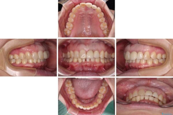 前歯のインプラント治療　折角なので矯正治療できれいな歯並びに 治療途中画像