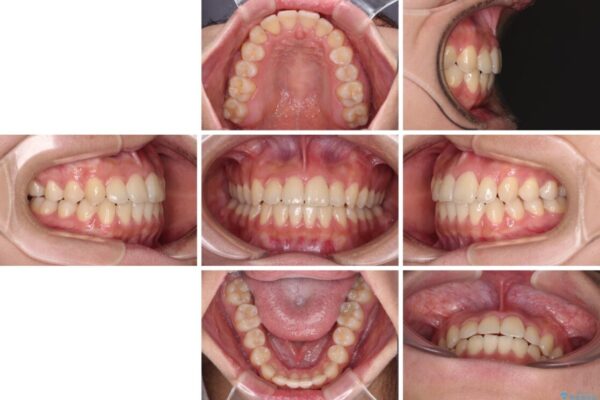 前歯のクロスバイトを短期間で解消　目立たないワイヤー矯正 治療後画像