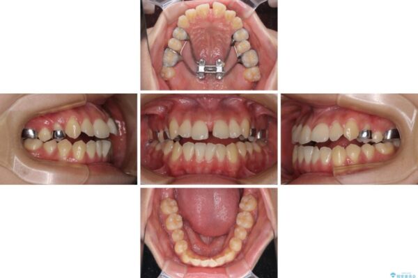 受け口と開咬を急速拡大装置とワイヤー装置で改善 治療前画像