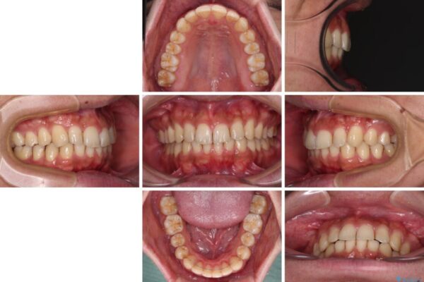 前歯のデコボコをスッキリ改善　インビザライン矯正 治療後画像