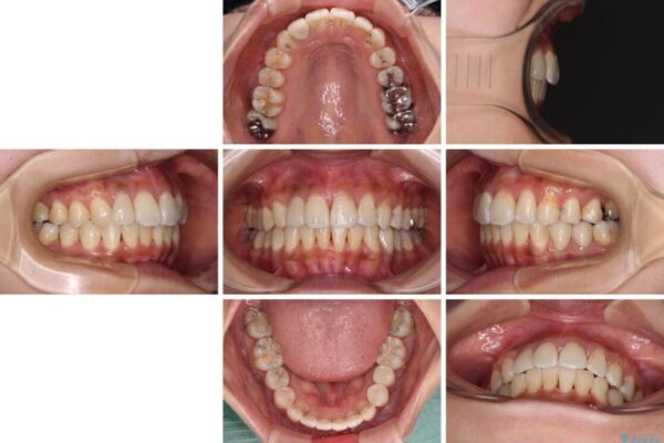 デコボコで磨きにくい前歯をスッキリと　インビザライン矯正 治療後画像