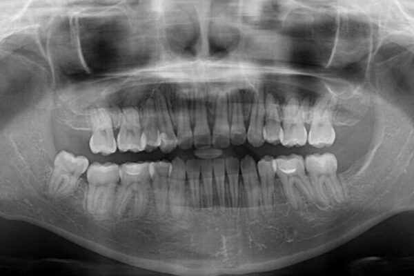 八重歯を抜歯矯正でスッキリと　メタルブラケットでの矯正治療 治療後画像