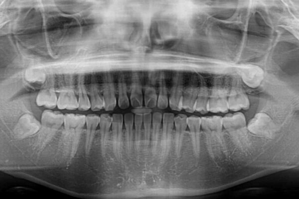 すきっ歯とオープンバイト　インビザライン・ライトで改善 治療前画像