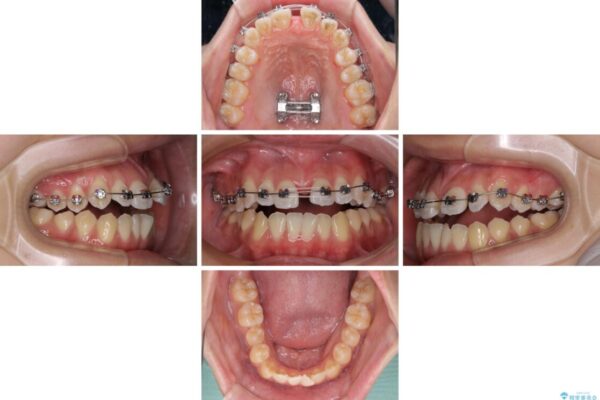 受け口と開咬を急速拡大装置とワイヤー装置で改善 治療途中画像