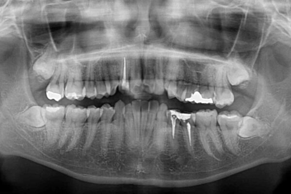 デコボコで磨きにくい前歯をスッキリと　インビザライン矯正 治療前画像