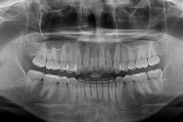 【モニター】八重歯と前歯のクロスバイト　ワイヤーを併用しインビザラインで矯正治療 治療後画像