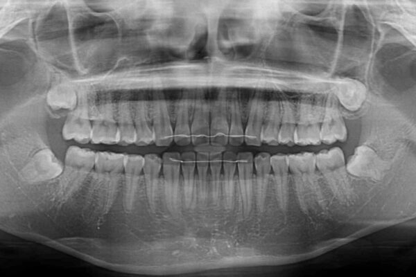 すきっ歯とオープンバイト　インビザライン・ライトで改善 治療後画像