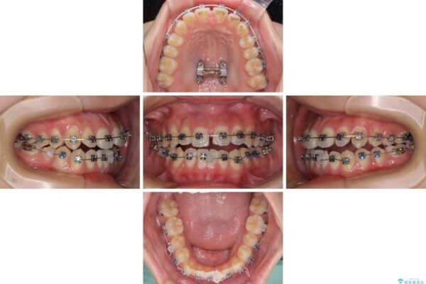 受け口と開咬を急速拡大装置とワイヤー装置で改善 治療後画像
