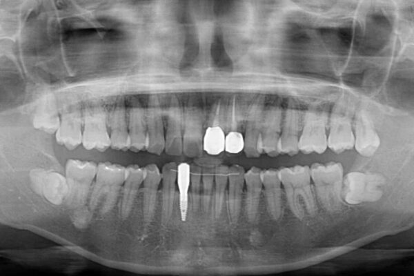 前歯のインプラント治療　折角なので矯正治療できれいな歯並びに 治療後画像