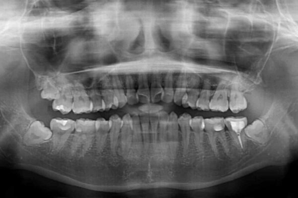 前歯のクロスバイト　ワイヤー装置を併用したインビザライン矯正 治療前画像