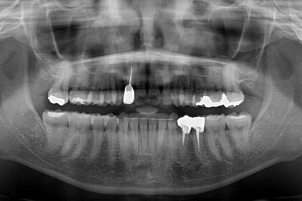 デコボコで磨きにくい前歯をスッキリと　インビザライン矯正 治療後画像