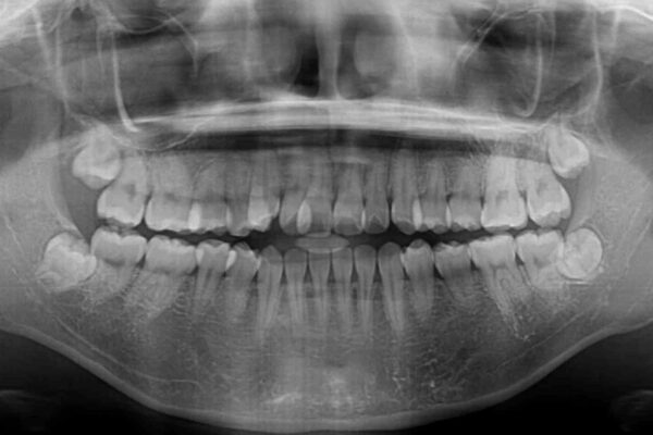 急速拡大装置　狭い上顎骨を拡大してワイヤー装置で短期間治療 治療前画像