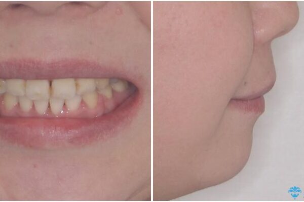 出っ歯による口の閉じにくさを治したい　ワイヤー装置を用いた抜歯矯正 治療後画像