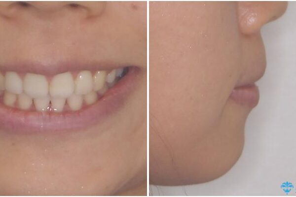 前歯の出っ歯と口の閉じにくさが気になる　目立たないワイヤー装置での抜歯矯正 アフター