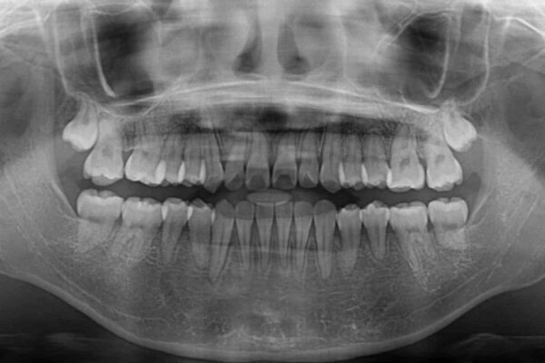 急速拡大装置　狭い上顎骨を拡大してワイヤー装置で短期間治療 治療後画像