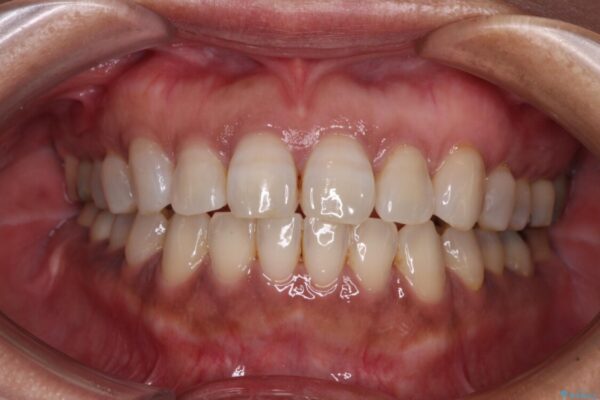 極端な上下前歯の開咬を改善　オープンバイトのインビザライン矯正 アフター