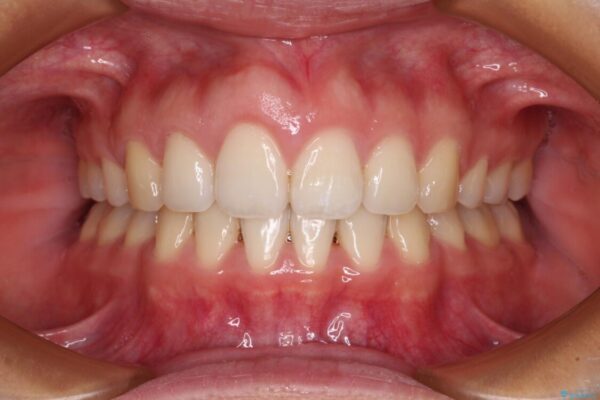 前歯の出っ歯と口の閉じにくさが気になる　目立たないワイヤー装置での抜歯矯正 治療後画像