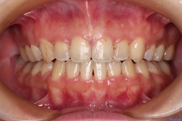 八重歯を抜歯矯正でスッキリと　メタルブラケットでの矯正治療 アフター