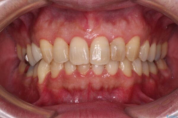 外側に飛び出した歯　インビザラインによる矯正治療 治療後画像