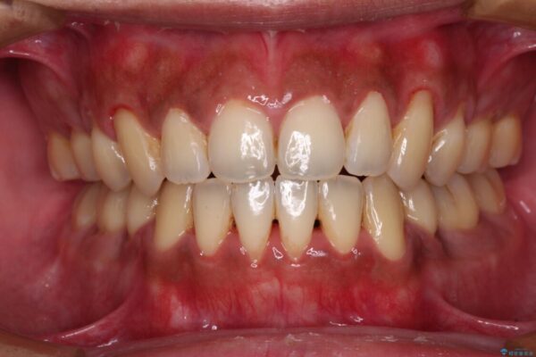隙間が空いて突出した前歯を治したい　ワイヤー装置による抜歯矯正 治療後画像