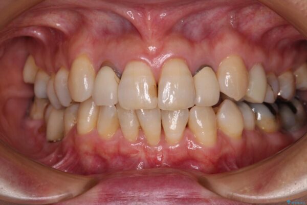 歯根が見えてしみる　歯肉移植による歯肉退縮の改善 アフター