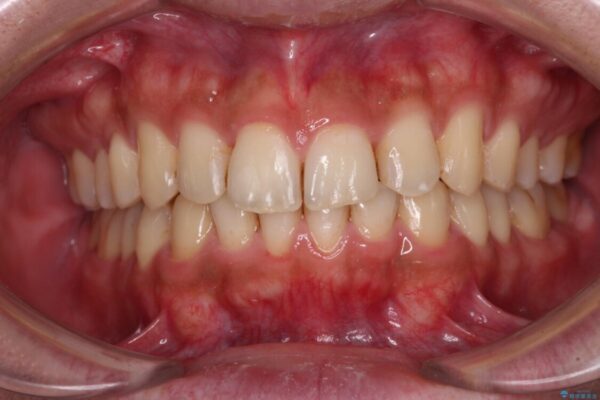 前歯のデコボコをスッキリ改善　インビザライン矯正 アフター