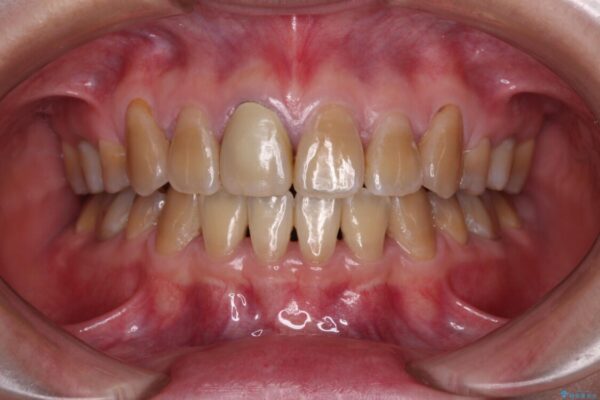 八重歯とクロスバイト　目立たないワイヤー装置での抜歯矯正 治療後画像